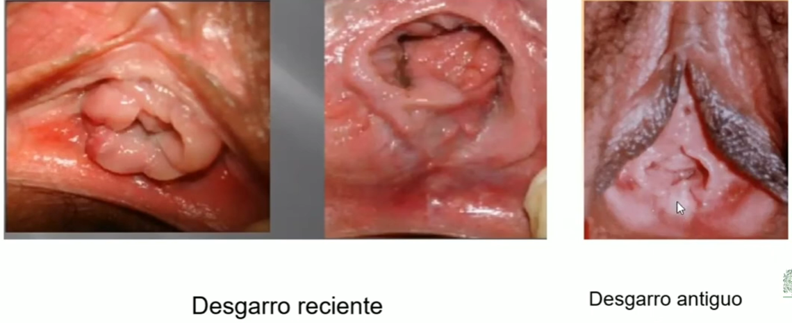 Ejemplos de lesiones en genitalesfgs.png